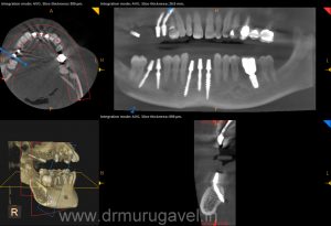 missing lower front teeth replacement