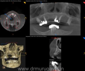 full mouth rehabilitation