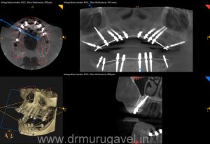 full mouth rehabilitation