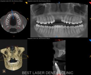 front teeth replacement