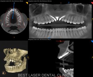 front teeth replacement