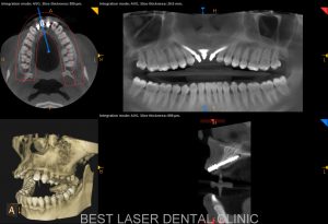 front teeth replacement