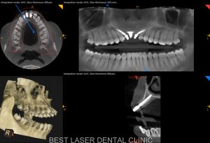 front teeth replacement