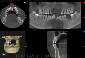 removable denture replacement with basal implants