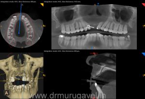 missing front teeth replacement with basal implants