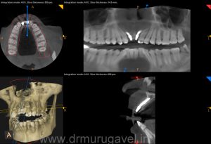 missing front teeth replacement with basal implants