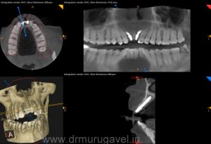 missing front teeth replacement with basal implants