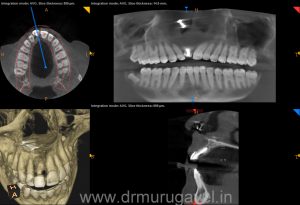 fixed teeth in single day