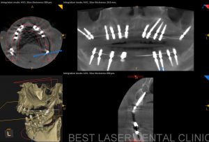 removable denture replacement with basal implants