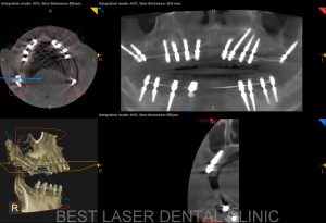 removable denture replacement with basal implants