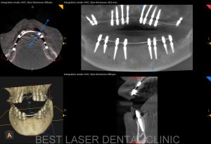 removable denture replacement with basal implants