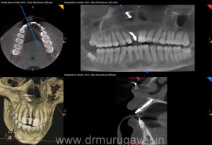 fixed teeth in single day