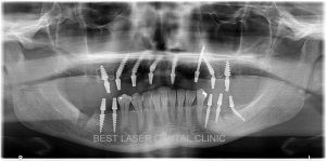 upper teeth replacement