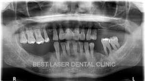 multiple missing and mobile teeth replacement