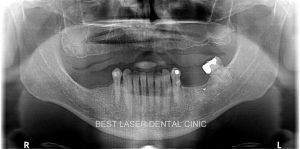 esthetic smile with strategic implants