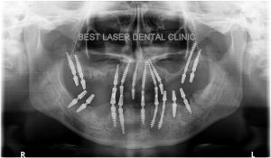 multiple missing and mobile teeth replacement