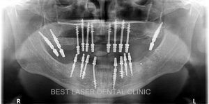 esthetic smile with strategic implants