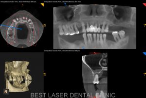 multiple missing and mobile teeth replacement