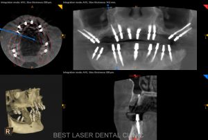 multiple missing and mobile teeth replacement