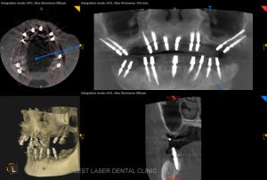 multiple missing and mobile teeth replacement