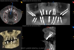 multiple missing and mobile teeth replacement