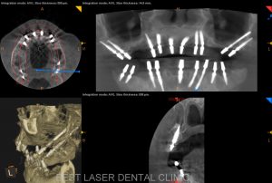 multiple missing and mobile teeth replacement