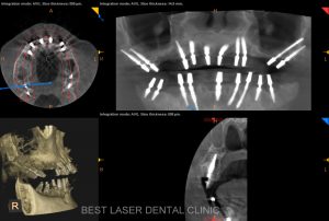 multiple missing and mobile teeth replacement