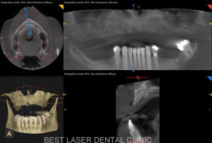 esthetic smile with strategic implants