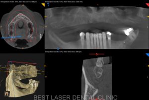 esthetic smile with strategic implants