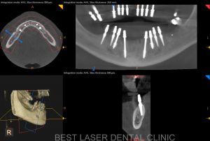 esthetic smile with strategic implants