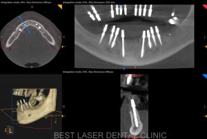 esthetic smile with strategic implants