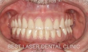 esthetic smile with strategic implants