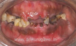 Fixed teeth in 3 days, basal implant