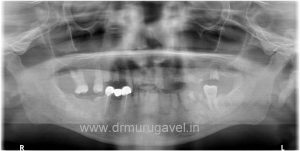 Fixed teeth in 3 days, basal implant