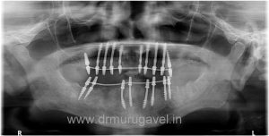 Fixed teeth in 3 days, basal implant