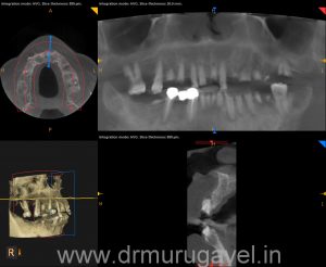 Fixed teeth in 3 days, basal implant