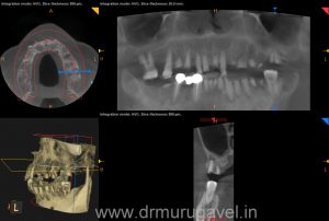 Fixed teeth in 3 days, basal implant