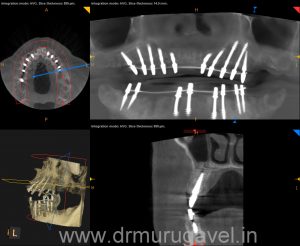 Fixed teeth in 3 days, basal implant