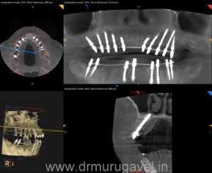 Fixed teeth in 3 days, basal implant