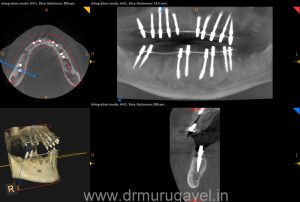 Fixed teeth in 3 days, basal implant