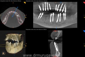 Fixed teeth in 3 days, basal implant