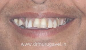 restoring smile and chewing