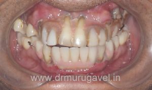 restoring smile and chewing