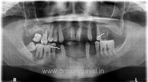 restoring smile and chewing