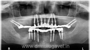 restoring smile and chewing