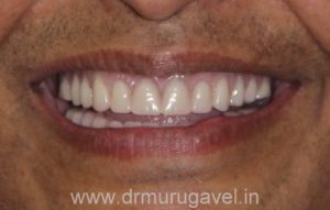 restoring smile and chewing