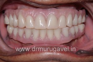 restoring smile and chewing