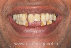 GET FIXED TEETH AND CONFIDENT SMILE IN JUST 3 DAYS