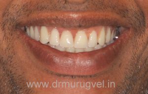 GET FIXED TEETH AND CONFIDENT SMILE IN JUST 3 DAYS