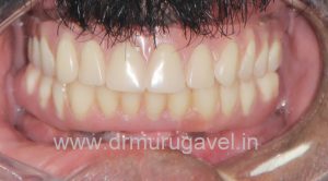 SMILE DESIGNING IN CHENNAI